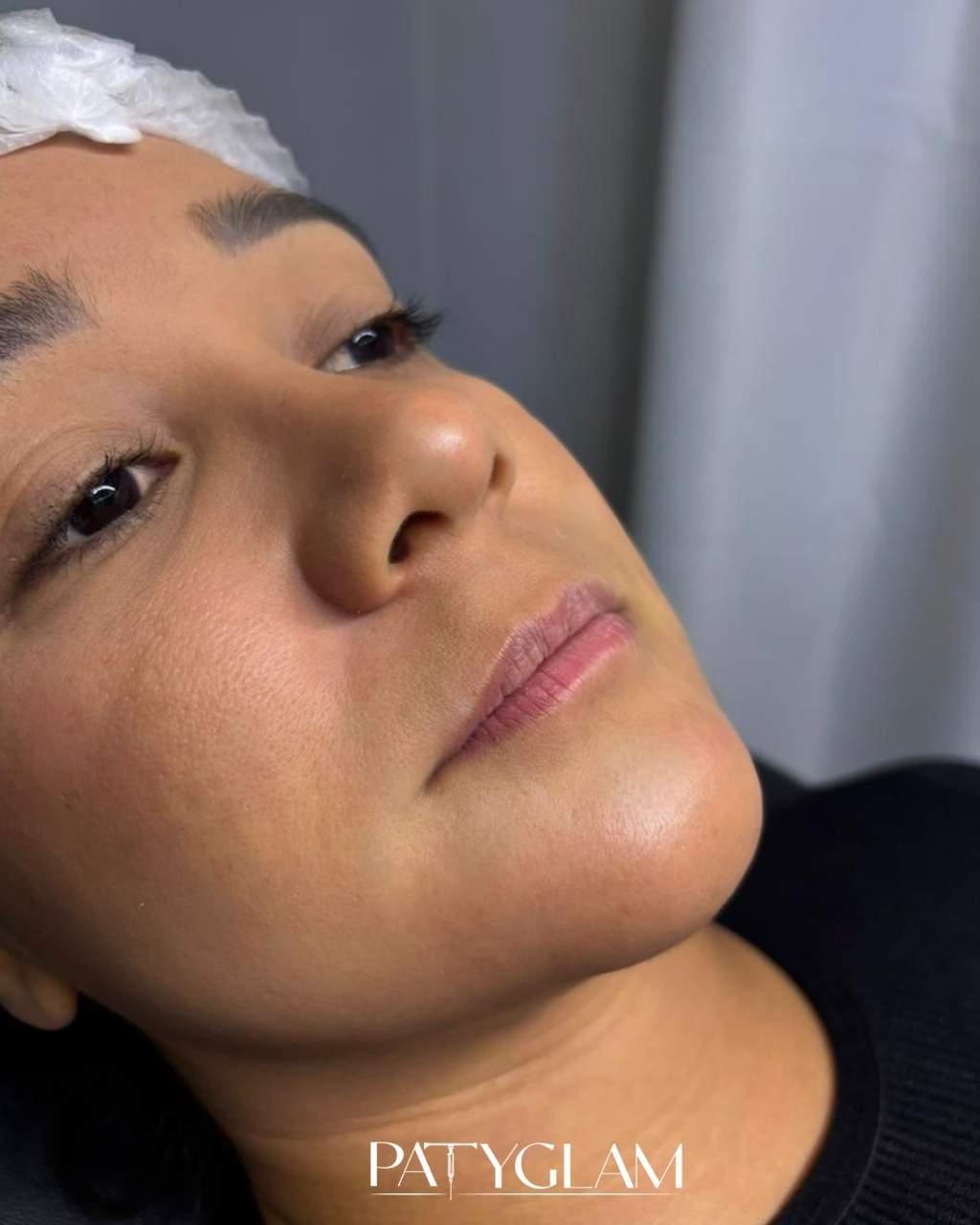 Antes - procedimento estético