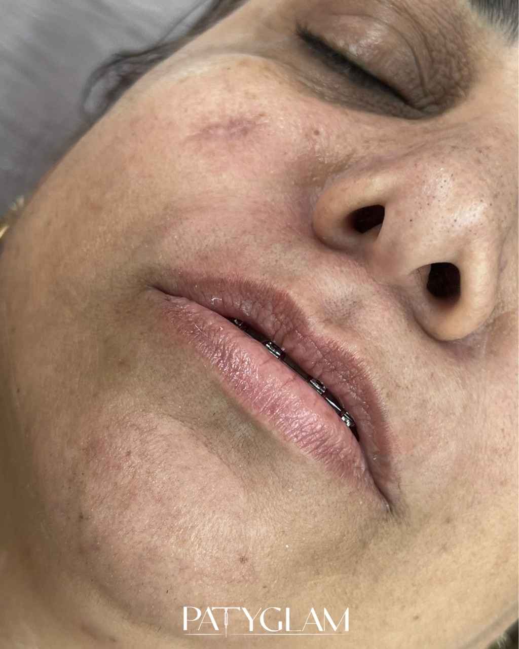 Depois - resultado do procedimento