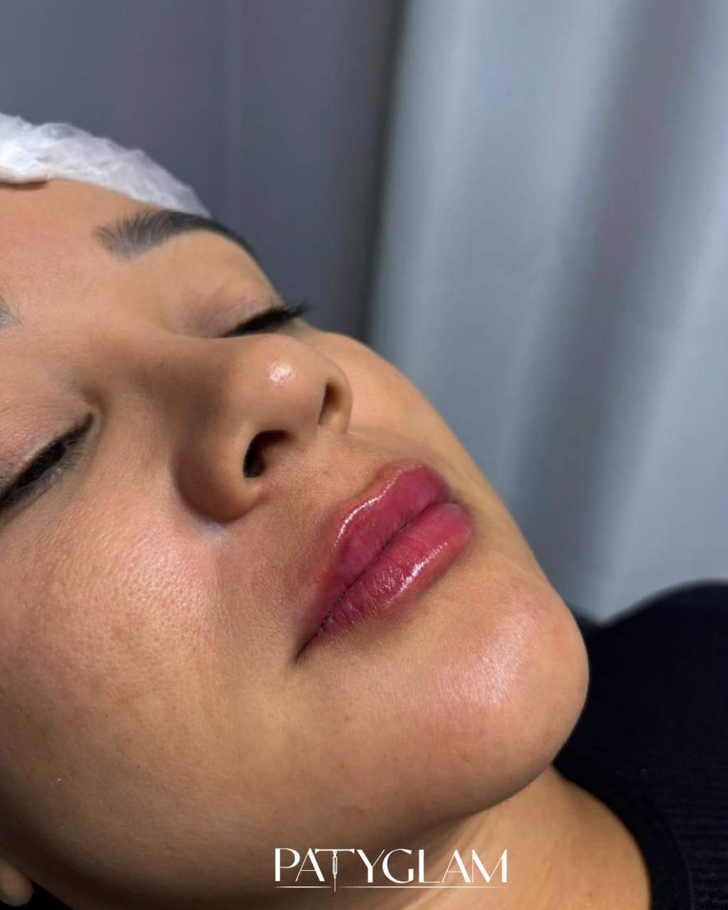 Antes - procedimento estético